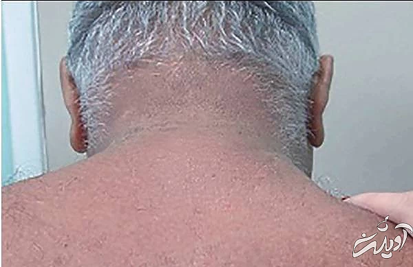 عوارض دیابت بر پوست اسکلرودرما دیابتیکروم